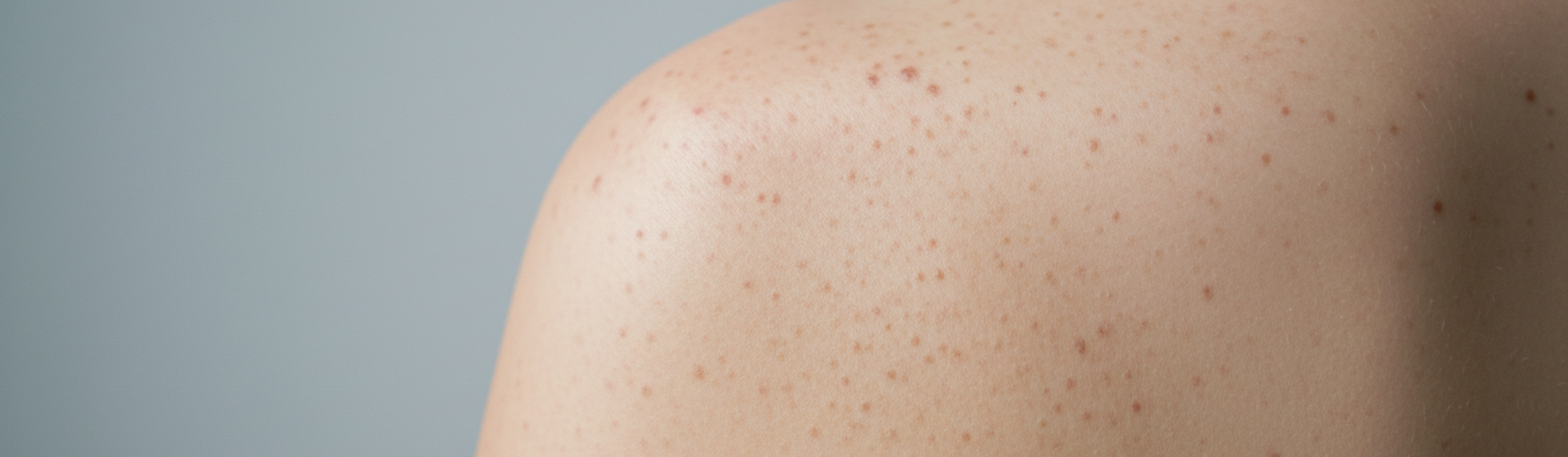 Maison du Laser - Centre d'épilation laser médical à Paris - Tarifs kératose pilaire